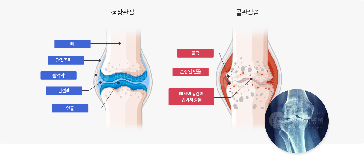 정상관절과 퇴행성관절염 비교 