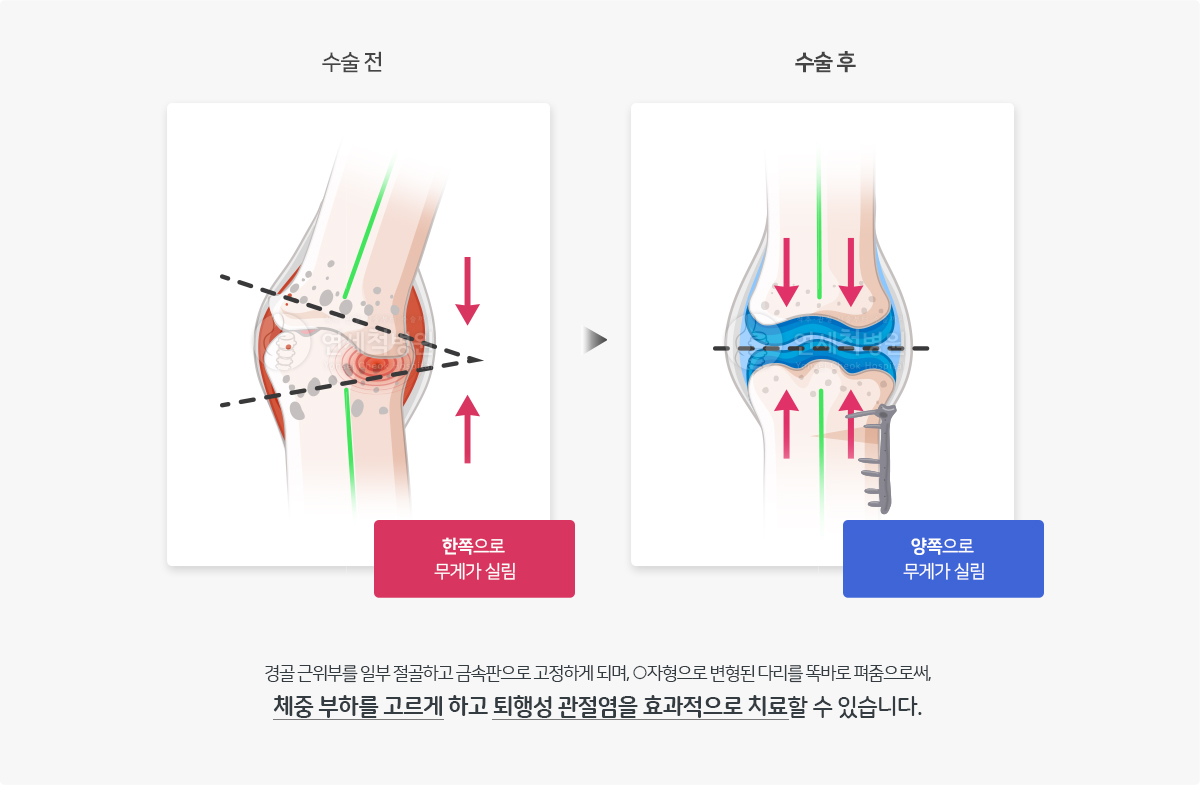 경골 근위부 절골술은 제중부하를 고르게하고 퇴행성 관절염을 효과적으로 치료할 수 있습니다.