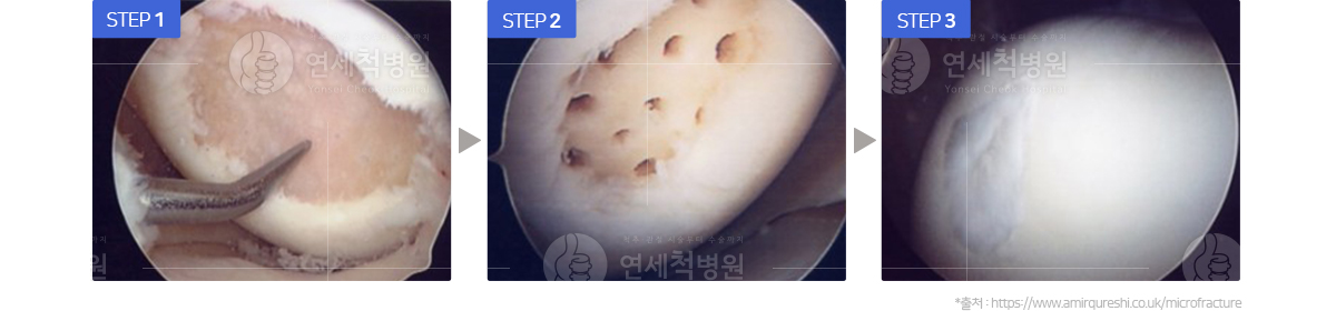 미세천공술을 이용한 치료단계