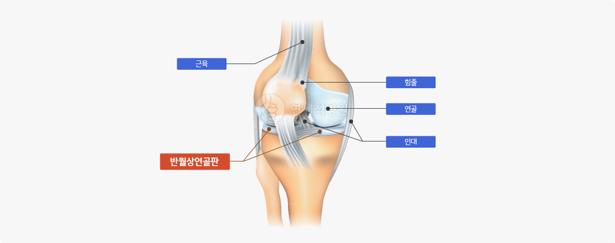 관절연골 병변 예시 이미지