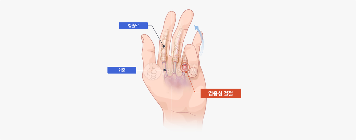 방아쇠 수지 예시 이미지