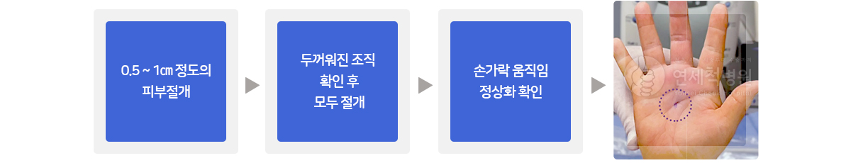 A1 활차 유리술 과정 이미지
