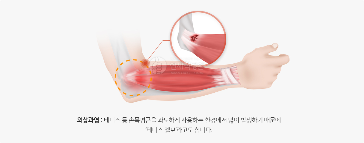 외상과염 : 테니스등 손목폄근을 과도하게 사용하는 환경에서 많이 발생하기 때문에 테니스 엘보라고도 합니다.