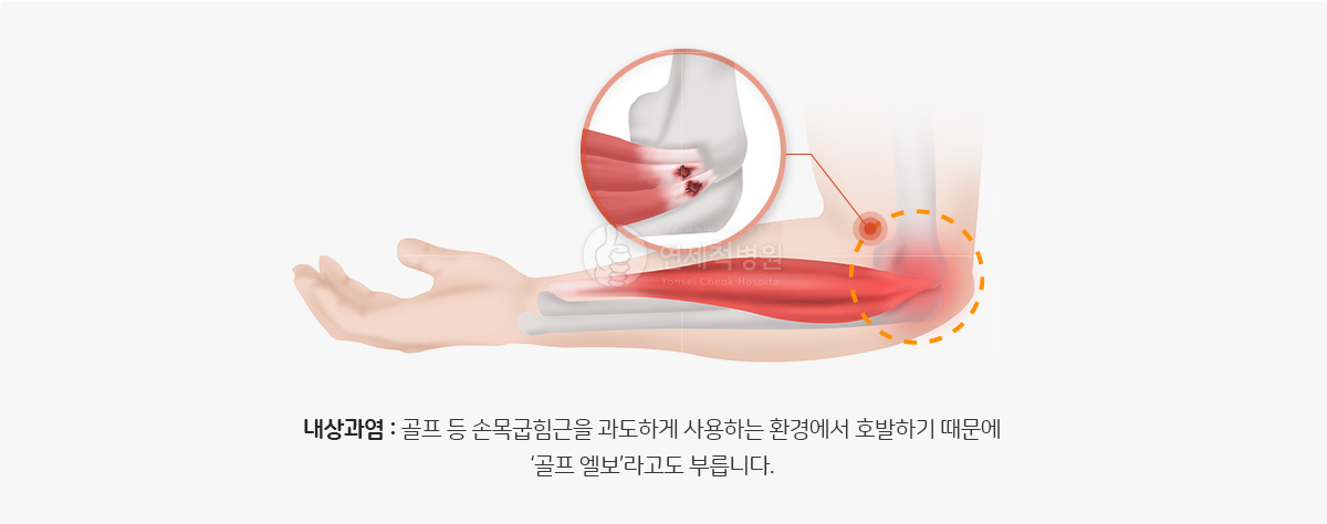 내강과염 : 골프등 손목굽힘근을 과도하게 사용하는 환경에서 호발하기 때문에 골프엘보아고도 부릅니다.