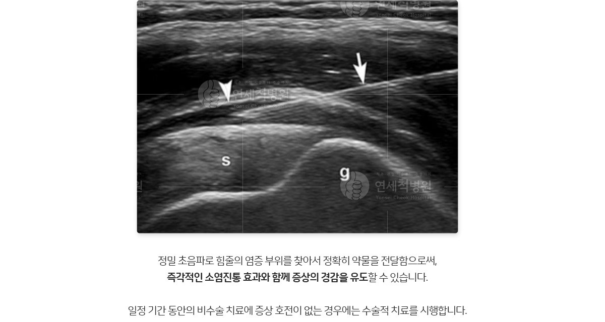 정밀 초음파로 힘줄의 염증 부위를 찾아서 정확히 약물을 전달함으로써, 즉각적인 소염진통 효과와 함께 증상의 경감을 유도할 수 있습니다.