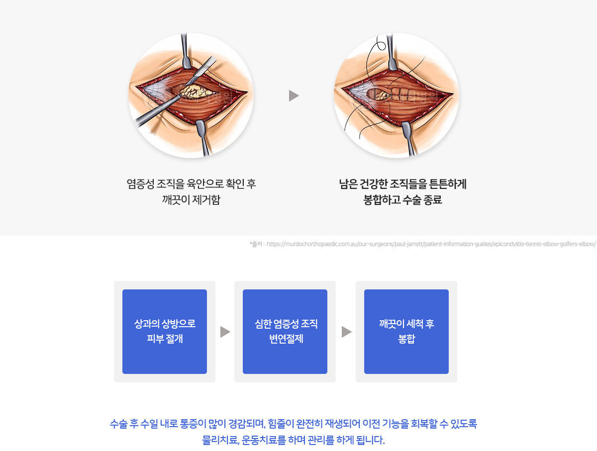 염증성 조직을 육안으로 확인 후 깨끗하게 제거 후 남은 건강한 조직들을 튼튼하게 봉합하고 수술 종료합니다.